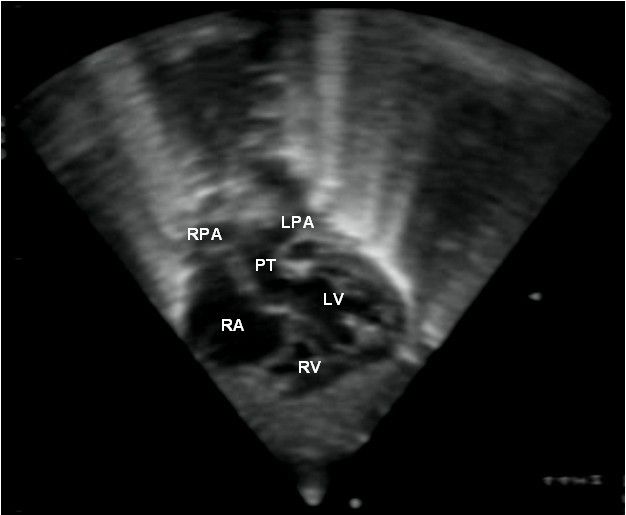 File:Transposition great arteries Orphanet 1750-1172-3-27-1.JPEG