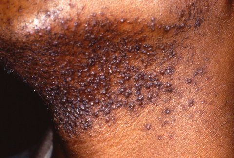 File:Pseudofolliculitis Barbae.jpg