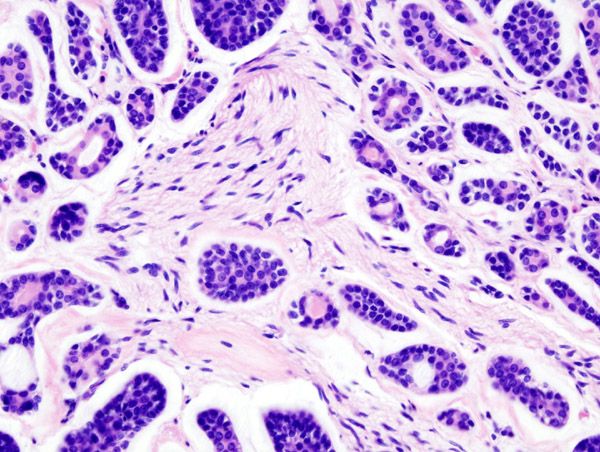 File:Adenoid cystic carcinoma (2).jpg