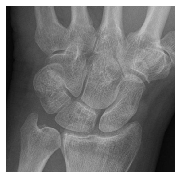 File:AP X-ray of dorsal triquetral fracture.jpg