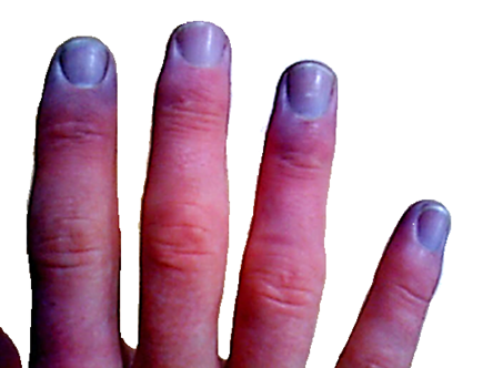 File:Cyanosis-adult fingertips.PNG