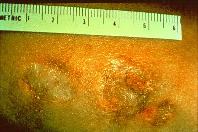 File:Granuloma.jpg