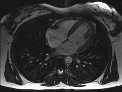 File:Cardiac mri slice bionerd.jpg