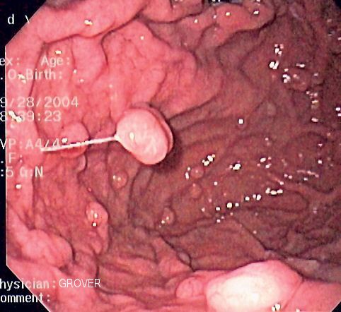 File:Fundic gland polyposis0001.jpg