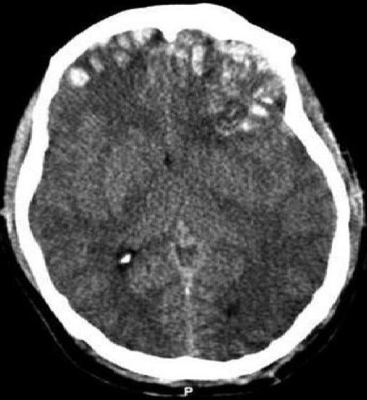 File:Brain trauma CT.jpg