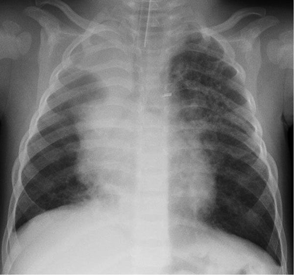 File:Human bocavirus 1 pneumonia.jpg