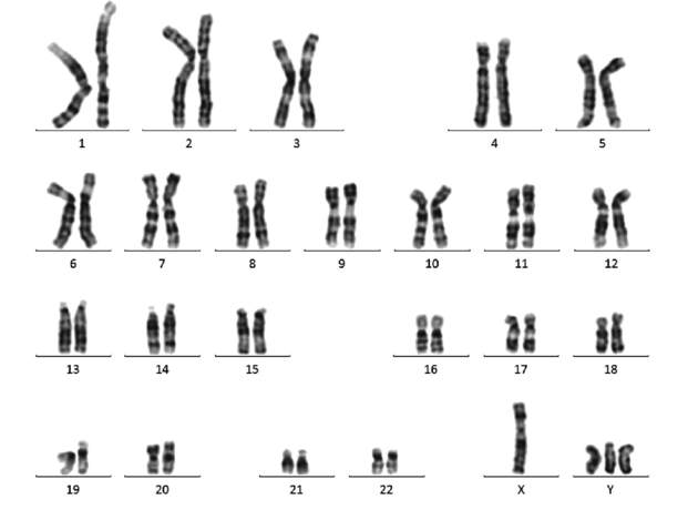 File:Peripheral-blood-karyotype-result-belonging-to-the-subject-compatible-with-48-XYYY.png