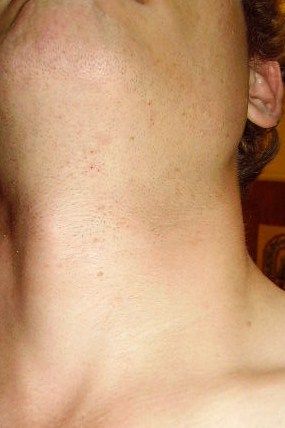 File:Pseudofolliculitis barbae.jpg