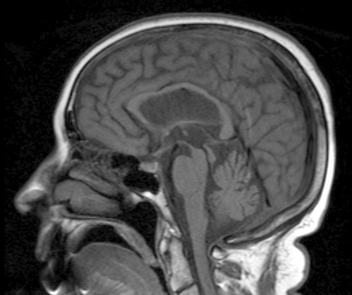 File:Steele-olszewski-richardson disease.jpg