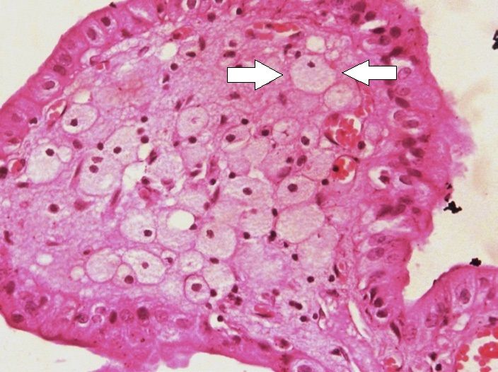 File:Histopathology of cholesterolosis, with annotated foam cell.jpg