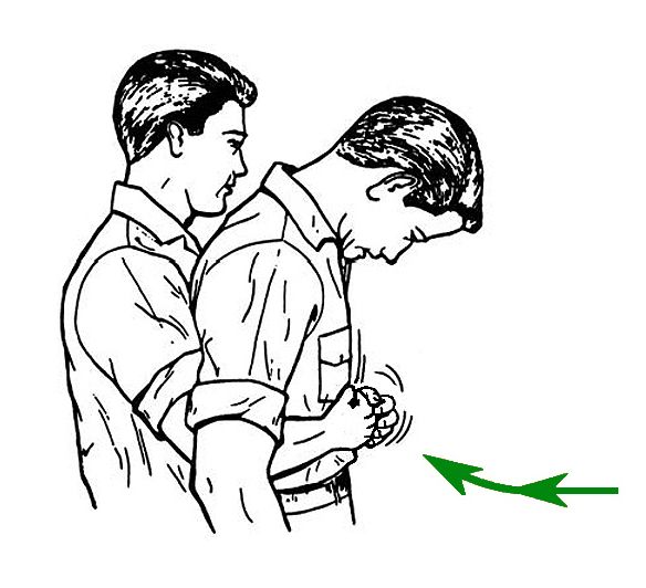 File:Abdominal thrusts against choking (cropped).jpg