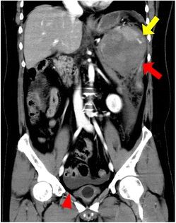 File:Hypertrophic accessory spleen with hematoma.jpg