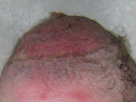 File:Vacuum Extraction bruised scalp.JPG