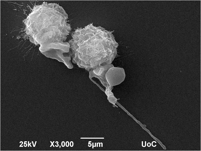 File:Anaplastic thyroid carcinoma cell No.2.jpg