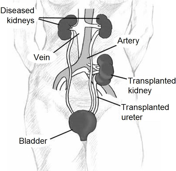 File:Kidtransplant.jpg