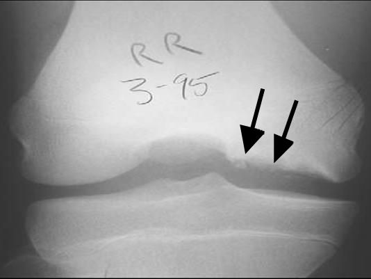 File:Osteochondritis dissecans diagram.JPEG