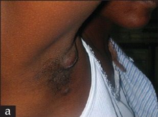 File:Rhipicephalus pulchellus bite armpit.jpg