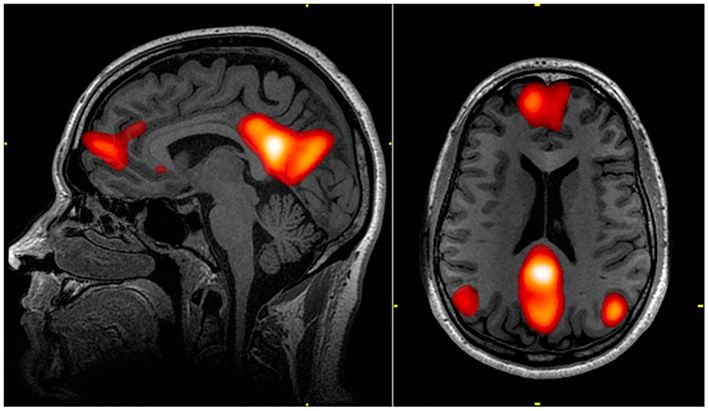 File:Default mode network-WRNMMC.jpg