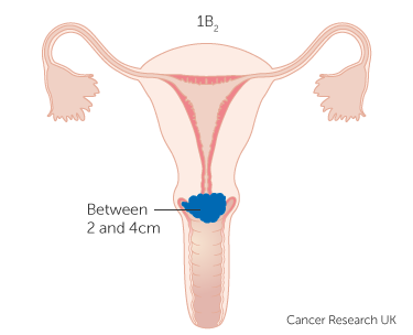 File:Diagram-showing-stage-1B2-cervical-cancer.png