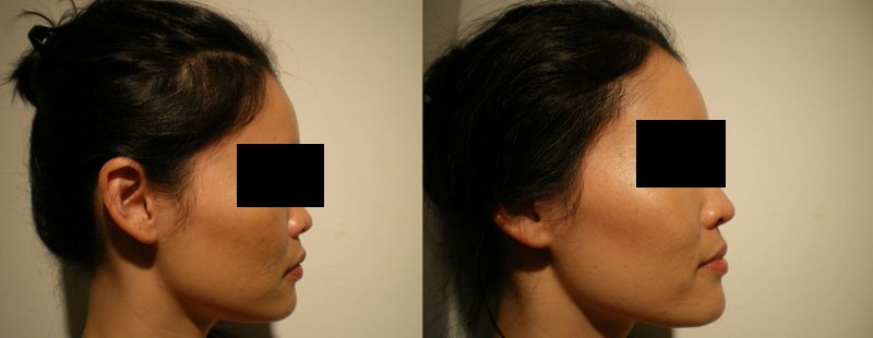 File:NonSurgicalRhinoplasty3.jpg