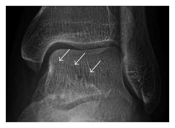 File:Subtle anterior talar fracture - X-ray.jpg