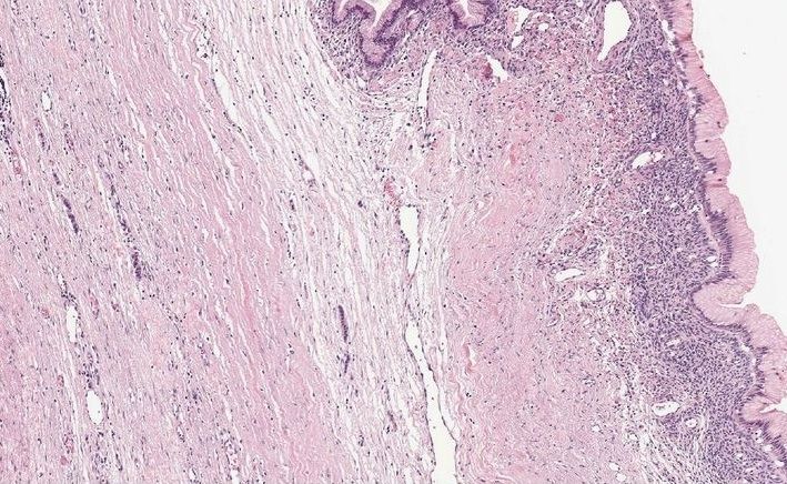 File:Mucinous cystadenoma of the pancreas 4.jpg