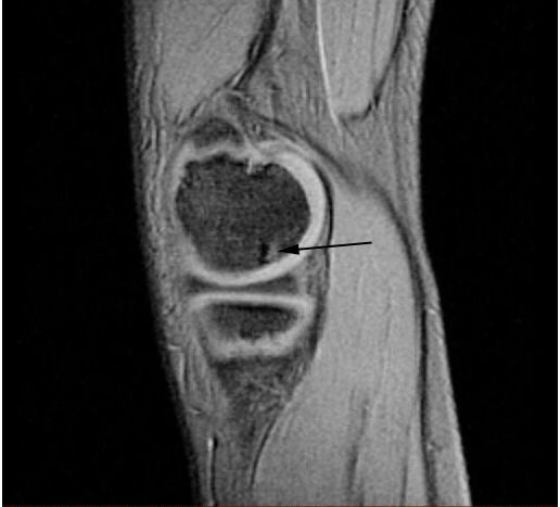 File:OCD WalterReed MRI-Sagital-T2.jpeg