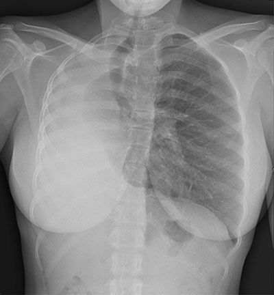 File:Pulmonaryhypoplasia.jpg