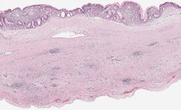 File:Mucinous cystadenoma of the pancreas 6.jpg