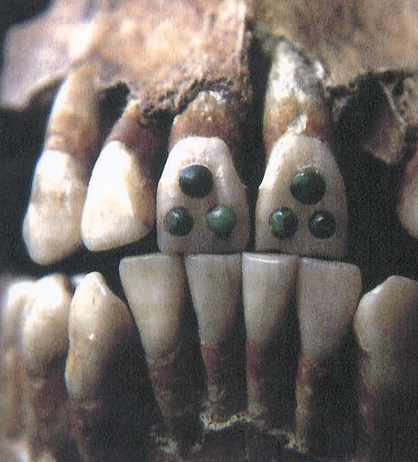 File:Inlay dental modification.png