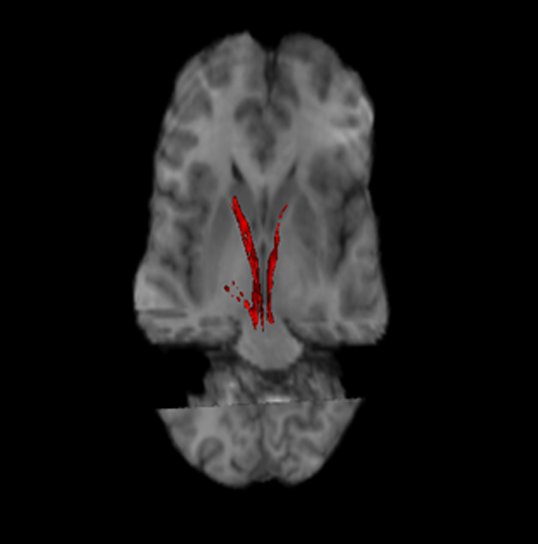 File:Nigrostriatal tract.png