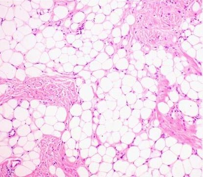 File:Histopathology of lipoma.jpg