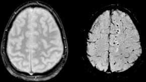 File:Compare SWI and GRE Trauma.png