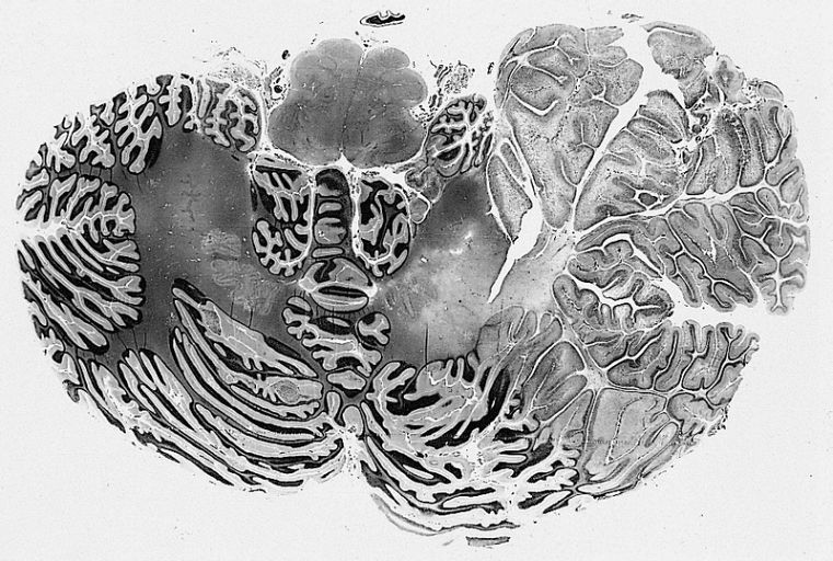 File:Dysplastic cerebellar gangliocytoma.jpg