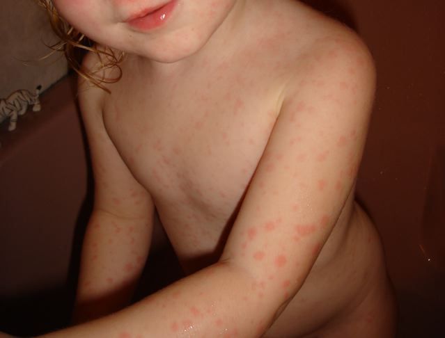 File:Erythema multiforme.jpg