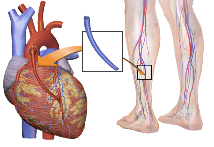 File:Blausen 0466 Heart Bypass Surgery.png