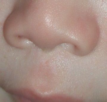 File:Philtrum FAS 6 months.jpg