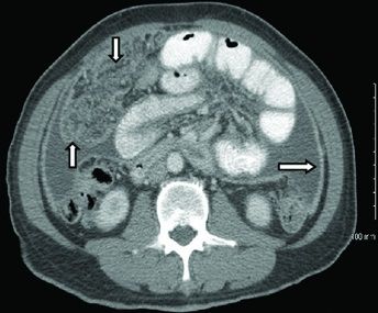 File:CT of peritoneal tuberculosis.jpg