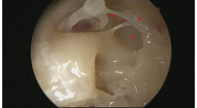 File:Sinus tympani.jpg