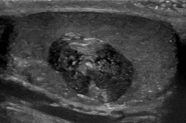 File:Epidermoid cyst testicle.jpg