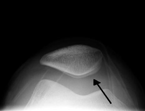 File:Knee effusion.jpg