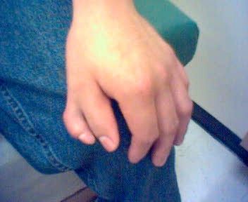 File:Polydactyly.jpg