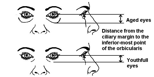 File:Distance cilliary margin orbicularis oculi.jpg