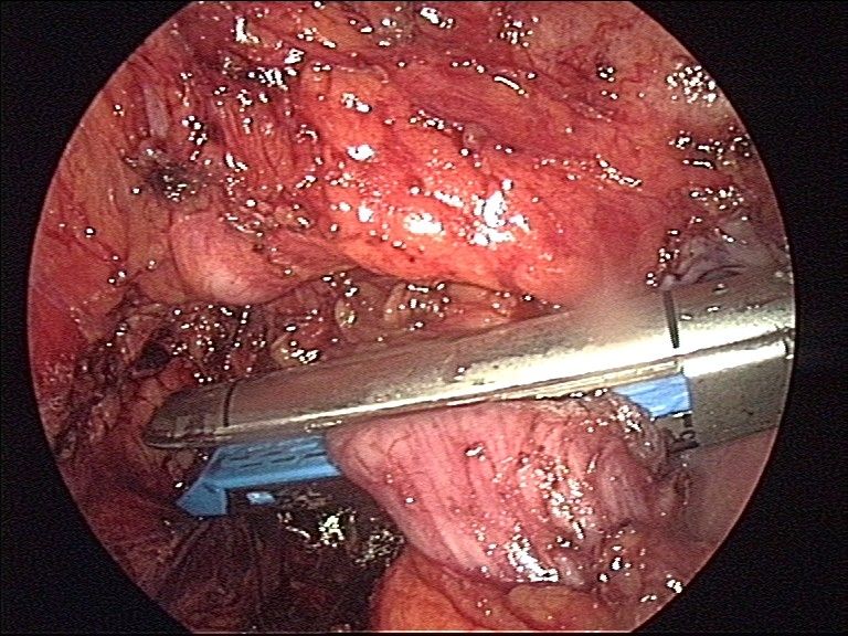 File:Stapler resection of sigma (laparoscopic) 1.jpg