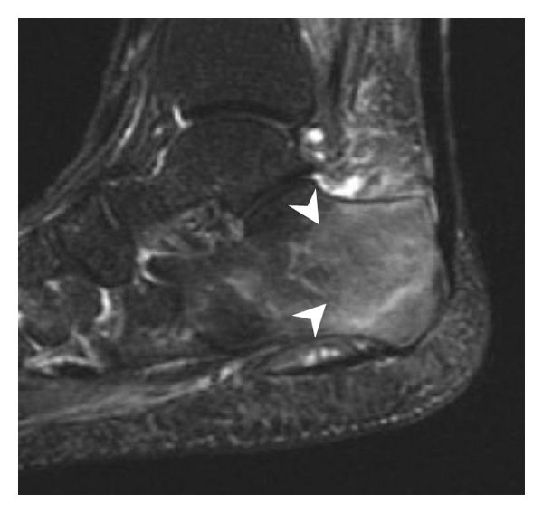 File:STIR MRI of of calcaneal fracture.jpg