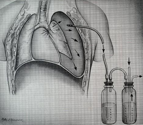 File:Main bronchus laceration.jpg