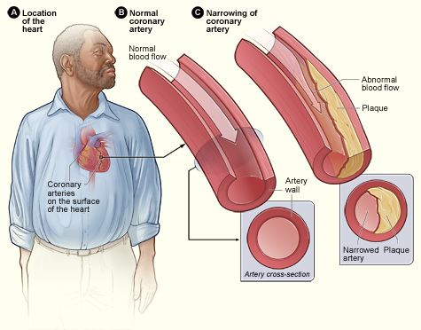 File:Atherosclerosis 2011.jpg