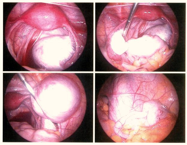 File:Endometriosis.jpg