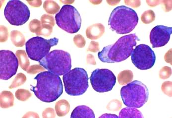 File:Acute lymphoblastic leukaemia smear.jpg