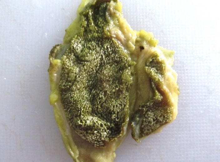 File:Gross pathology of cholesterolosis.jpg